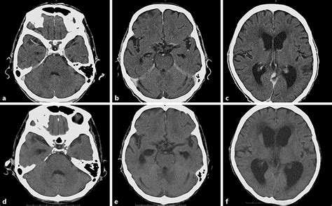 beyin tomografisi ve mr arasındaki fark